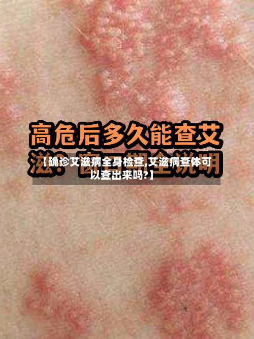 【确诊艾滋病全身检查,艾滋病查体可以查出来吗?】-第2张图片
