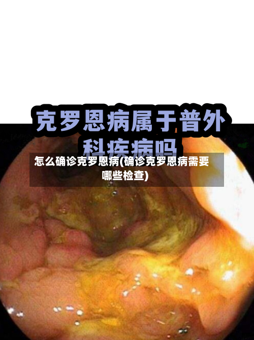 怎么确诊克罗恩病(确诊克罗恩病需要哪些检查)