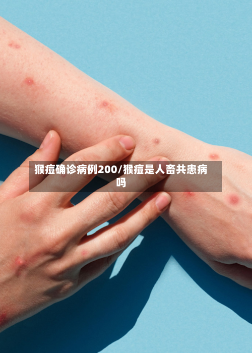 猴痘确诊病例200/猴痘是人畜共患病吗